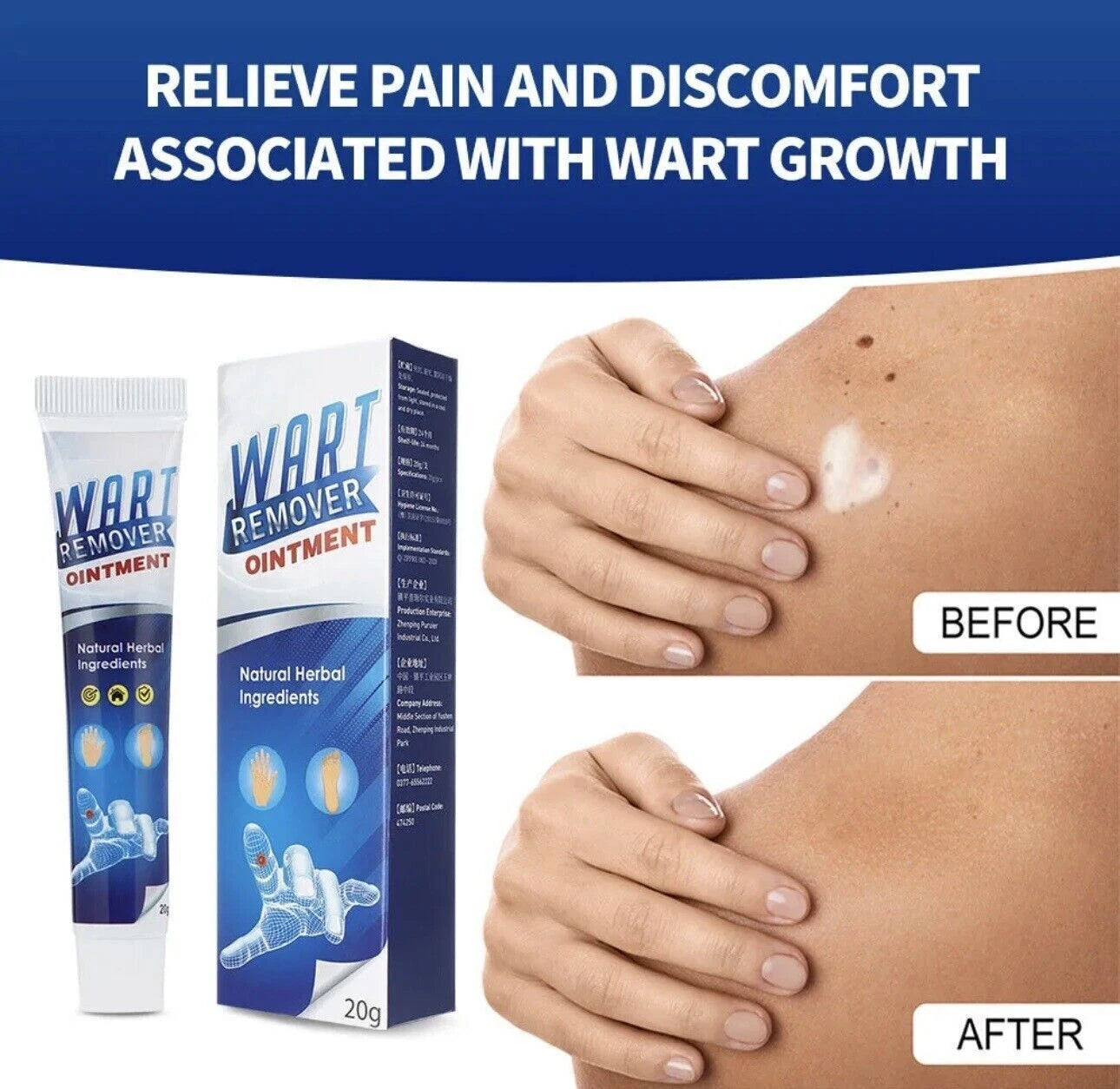 Warts Remover Cream